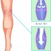 varicosevein diagram